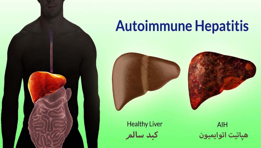 هپاتیت اتوایمیون تازه های تندرستی دکتر سعید شاه بیگی