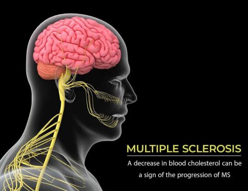نقش کلسترول در پیشرفت بیماری MS