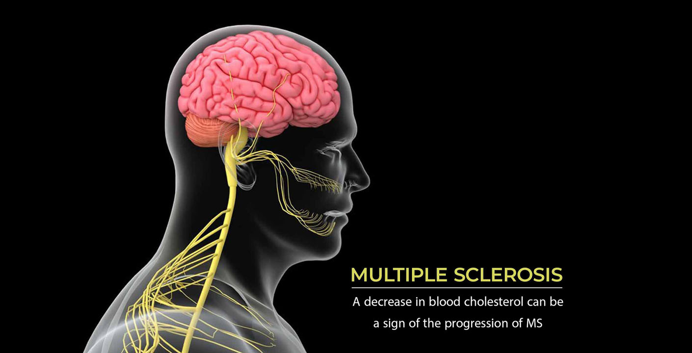 نقش کلسترول در پیشرفت بیماری MS