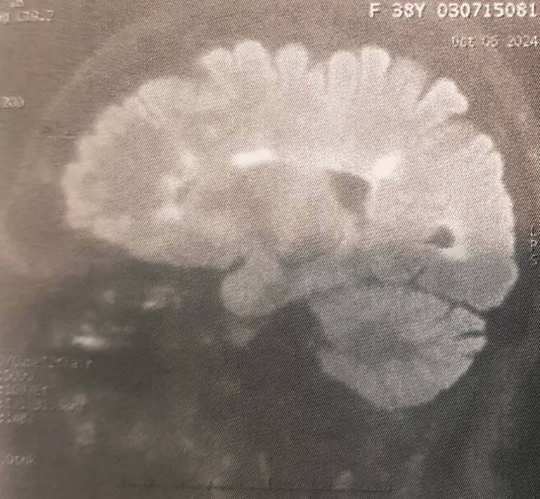 مطالعه موردی بیمار 35 ساله با مشکل ضعف اندام تحتانی بعد از زایمان