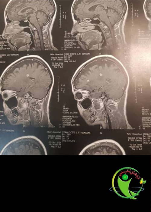 ام آر آی 2 مطالعه موردی بیمار 35 ساله با علامت پرش در سمت چپ صورت