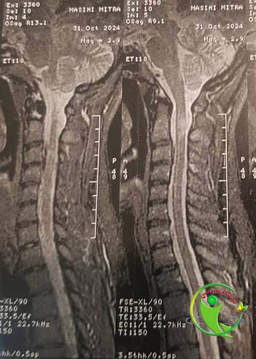 ام آر آی 1 مطالعه موردی بیمار 35 ساله با علامت پرش در سمت چپ صورت