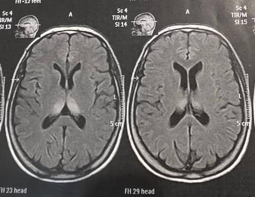PARANEOPLASTIC AUTOIMMUNE ENCEPHALITIS, A case discussion