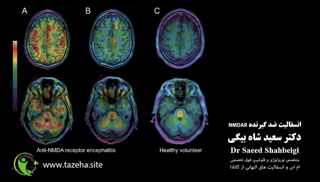 6. انسفالیت ضد گیرنده NMDA - دکتر سعید شاه بیگی نورولوژیست فلوشیپ فوق تخصصی ام اس و انسفالیت های التهابی از کانادا