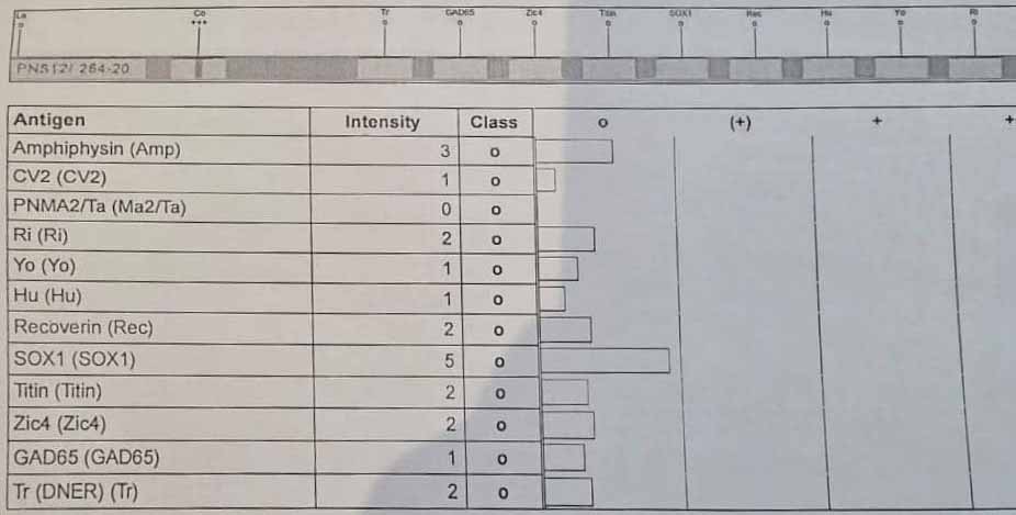Autoimmune Encephalitis after HSV Encephalitis دکتر سعید شاه بیگی متخصص مغز و اعصاب و فلوشیپ فوق تخصصی ام اس و انسفالیت های التهابی