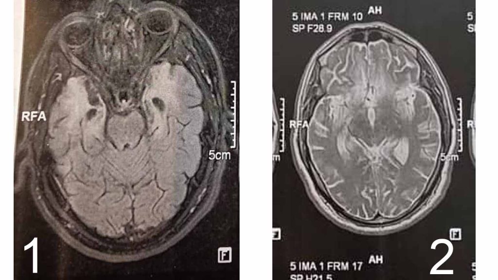 Autoimmune Encephalitis after HSV Encephalitis دکتر سعید شاه بیگی متخصص مغز و اعصاب و فلوشیپ فوق تخصصی ام اس و انسفالیت های التهابی