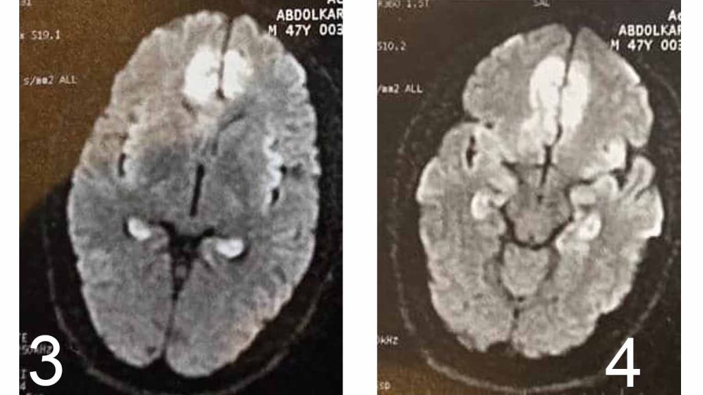 Autoimmune Encephalitis after HSV Encephalitis دکتر سعید شاه بیگی متخصص مغز و اعصاب و فلوشیپ فوق تخصصی ام اس و انسفالیت های التهابی