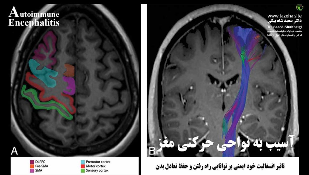 تاثیر انسفالیت خود ایمنی بر توانایی راه رفتن و حفظ تعادل بدن دکتر سعید شاه بیگی متخصص مغز و اعصاب و فلوشیپ فوق تخصصی ام اس و انسفالیت های التهابی مغز و نخاع از کانادا