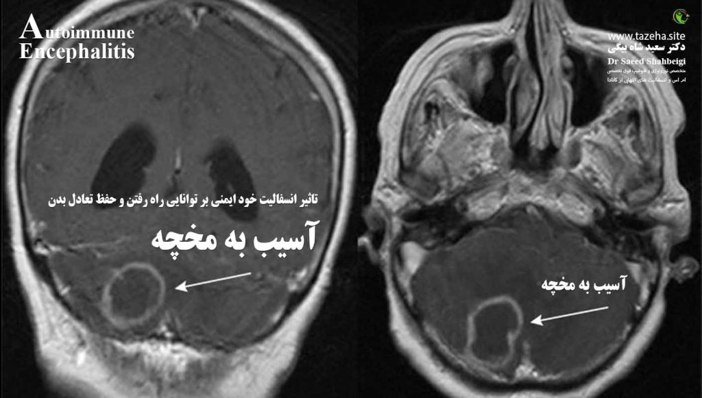 تاثیر انسفالیت خود ایمنی بر توانایی راه رفتن و حفظ تعادل بدن دکتر سعید شاه بیگی متخصص مغز و اعصاب و فلوشیپ فوق تخصصی ام اس و انسفالیت های التهابی مغز و نخاع از کانادا
