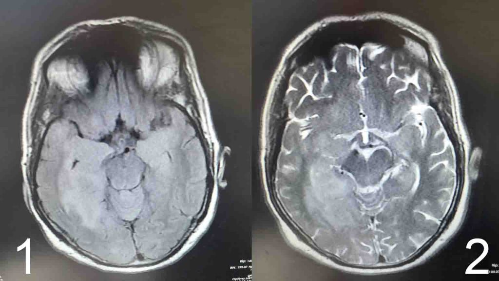 pic 1 and 2 : limbic-encephalitis-associated-with-anti_sox1-auto-antibodies-a-case-report