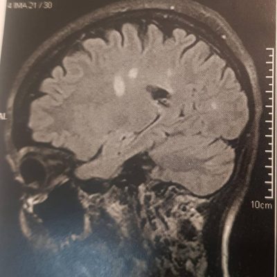 ام آر آی 1 = مطالعه موردی بالینی بیمار خانم 35 ساله با توانایی راه رفتن کمتر از 100 متر به تنهایی - دکتر سعید شاه بیگی