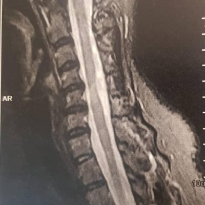 ام آر آی 4 = مطالعه موردی بالینی بیمار خانم 35 ساله با توانایی راه رفتن کمتر از 100 متر به تنهایی - دکتر سعید شاه بیگی